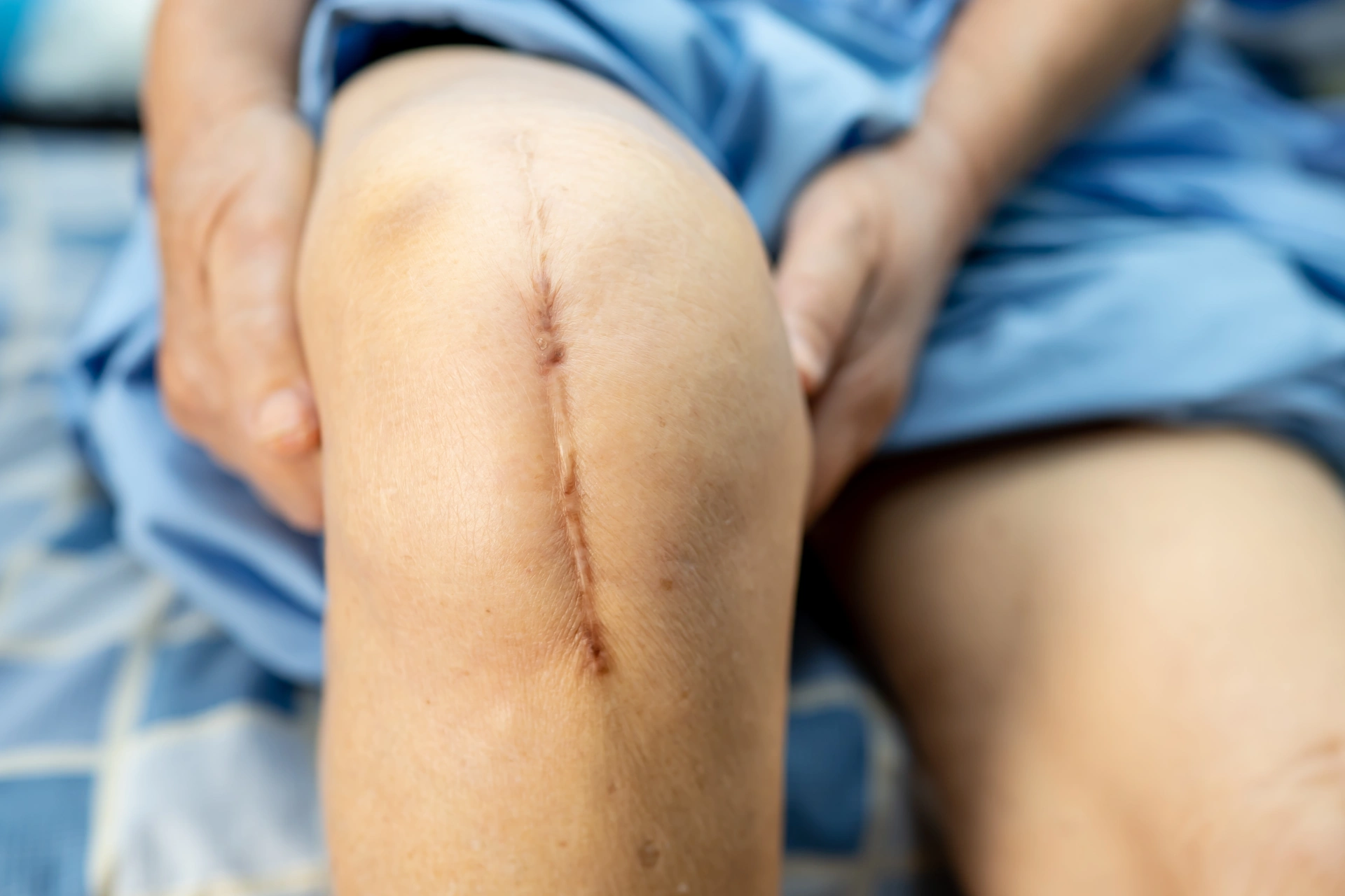 Littekens - Fysiotherapie Quickfit